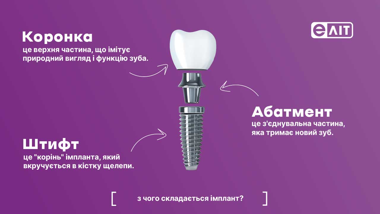 Имплантация зубов в ELIT Киев