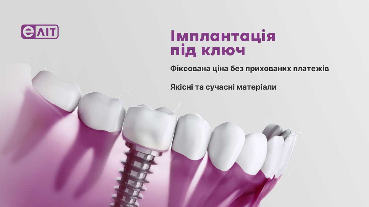 Импланты зубов в Киеве